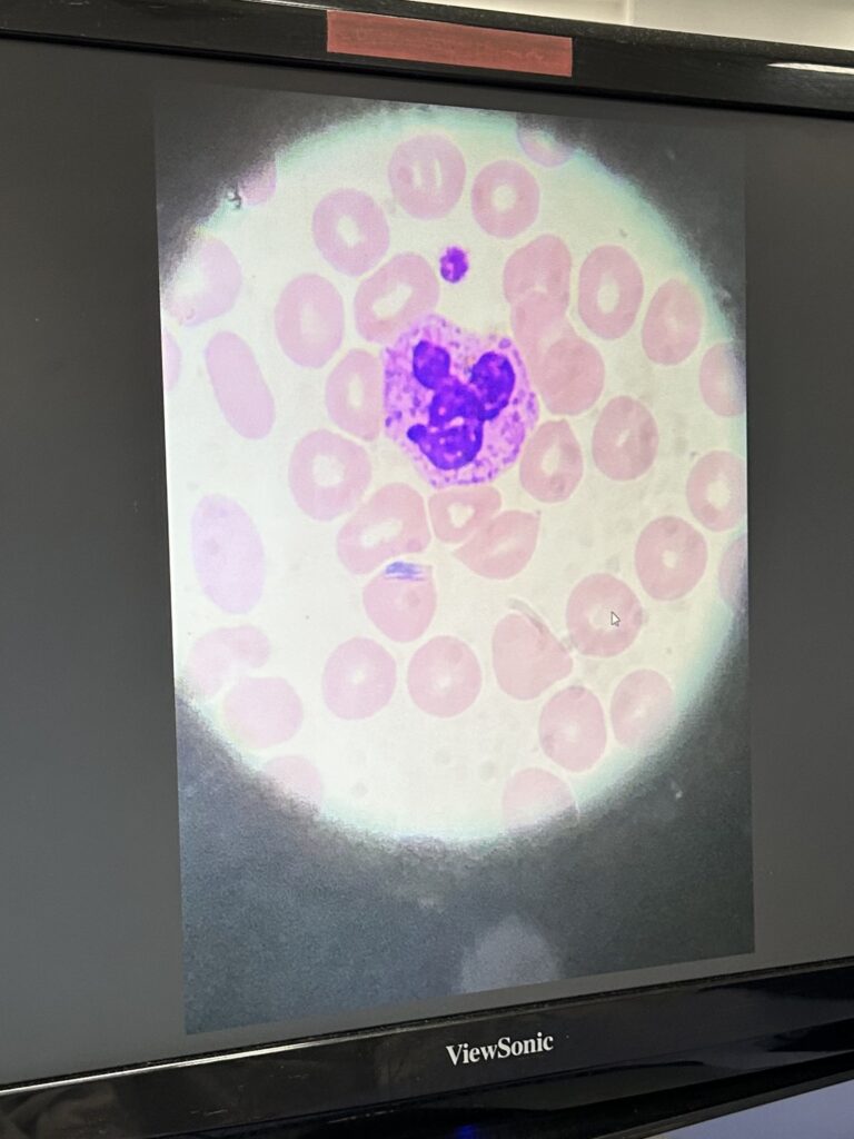 A blood cell formation that looked just like Mickey Mouse.